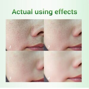 20ml Salicylic Acid Pores Refining Cream Shrink Pore Improve Acnes Blackheads Whitening Cream Anti-aging Oil Control Skin Care - Image 4