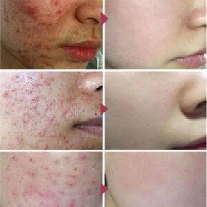 Effective Acne Removal Cream Acne Treatment Fade Acne Spots Oil Control Anti-Acne Shrink Pores Whiten Face Gel Skin Care - Image 2
