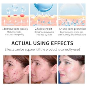 Effective Acne Removal Cream Acne Treatment Fade Acne Spots Oil Control Anti-Acne Shrink Pores Whiten Face Gel Skin Care - Image 3