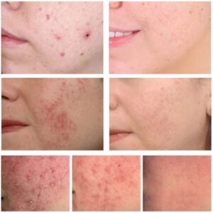 Effective Acne Removal Cream Acne Treatment Fade Acne Spots Oil Control Anti-Acne Shrink Pores Whiten Face Gel Skin Care - Image 4